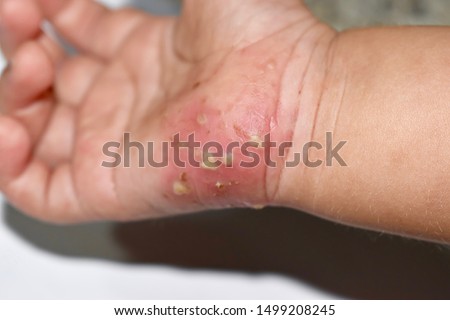 Scabies Infestation with secondary or superimposed bacterial infection in right hand of Southeast Asian, Burmese Child. A contagious skin condition caused by mites. Main symptom is intense itching. Royalty-Free Stock Photo #1499208245