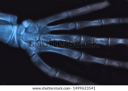Medical x-ray image of human hand. Radiology diagnostic of skeleton bones.
