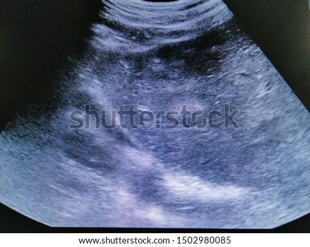 Ultrasound shows a picture of weird beautiful circular mass in human liver . It look like a cancerous mass or liver cancer . Medical and healthcare shot. Ultrasound concept