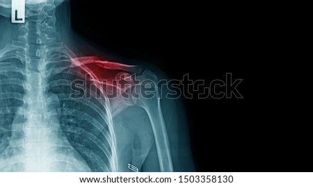 x-ray image of shoulder pain with clavicle fracture and copy space  Royalty-Free Stock Photo #1503358130