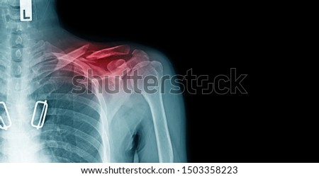 x-ray image of shoulder pain with clavicle fracture and copy space  Royalty-Free Stock Photo #1503358223