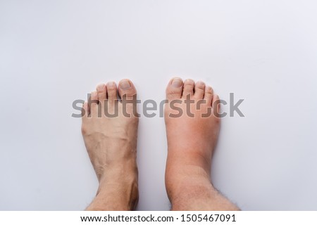 Right feet sprain swelling from trauma on white background. Royalty-Free Stock Photo #1505467091