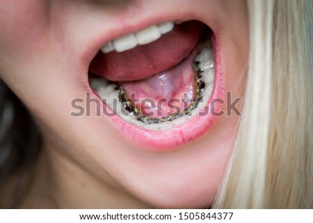 young blonde girl laughs and shows internal lingual invisible braces, mouth close-up, blurred background Royalty-Free Stock Photo #1505844377