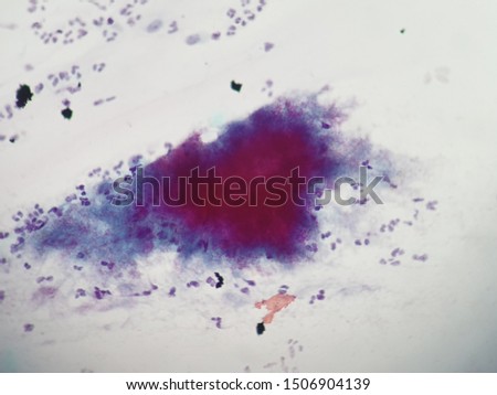 Actinomyces species view in microscopy, Pap  smear  slide cytology. medical background.

