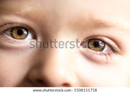 Conjunctivitis in a small child. Dried discharge from the eye on the eyelashes. Royalty-Free Stock Photo #1508151758