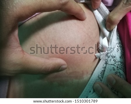 This patient is having anterior abdominal abscess presented with reddish discolouration of skin with lump Royalty-Free Stock Photo #1510301789