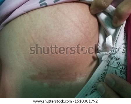 This patient is having anterior abdominal abscess presented with reddish discolouration of skin with lump Royalty-Free Stock Photo #1510301792