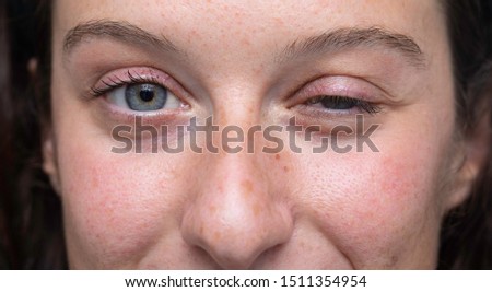 close up on blue eyes girl face with one half closed eye, Myasth Royalty-Free Stock Photo #1511354954