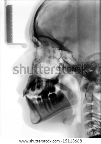 X-ray picture of the Cranium of the person