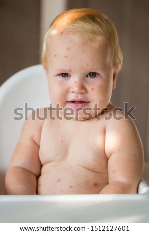The child is sick with varicella. Measles. The child sits in a feeding chair and eats a banana. Food allergy. No vaccination.