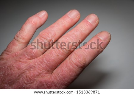 Hand of a psoriasis patient close-up. Psoriatic arthritis. Joint deformation and inflammation on the skin. Photo with dark vignetting.Soft focus.