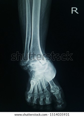 X-ray Right Ankle joint (AP) Finding flattening talus and deformity of right ankle and joint space is not narrow.Medical and healthcare concept.
