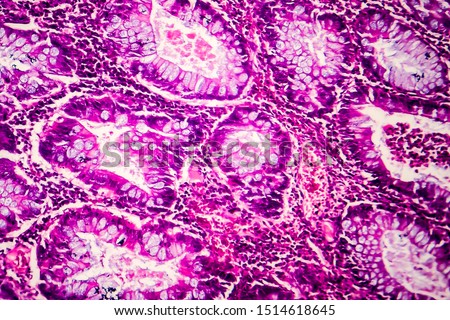 Villous colon adenocarcinoma, light micrograph, photo under microscope Royalty-Free Stock Photo #1514618645
