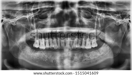Panoramic film showed osteolytic lesion due to osteoradionecrosis of lower jaw. patient history of tongue resection and radiotherapy.  Royalty-Free Stock Photo #1515041609