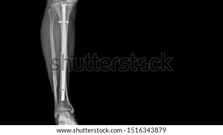 Film leg X-ray radiograph showing leg bone broken (tibia fracture) which treated by close reduction and internal fixation (CRIF) with tibial nail device. Medical equipment and technology concept Royalty-Free Stock Photo #1516343879