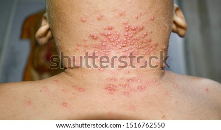 Multiple small pustules or numerous Staphylococcal / Streptococcal skin infection in neck of Asian Burmese male three years old patient in clinic of Myanmar. Royalty-Free Stock Photo #1516762550