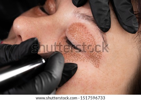 Women eyelid lifting, fibroblast procedure. Royalty-Free Stock Photo #1517596733
