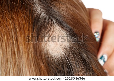 30 year old Caucasian woman with spot alopecia, bald spot on her head Royalty-Free Stock Photo #1518046346