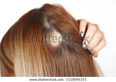 30 year old Caucasian woman with spot alopecia, bald spot on her head Royalty-Free Stock Photo #1518046355