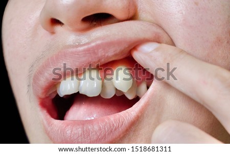 Malocclusion, Overcrowding of upper teeth including canine in Southeast Asian, Chinese young man. Royalty-Free Stock Photo #1518681311