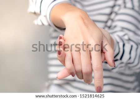Close up: Hands of a woman with first degree heat burn scar about a months after injured. The wound damage on epidermis outermost layer of skin and now it's in healing process, Scar fading remedies. Royalty-Free Stock Photo #1521814625