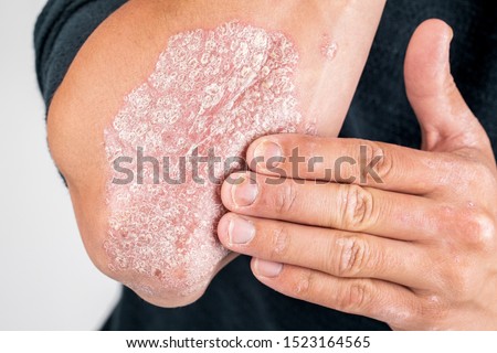 the use of emollient for dry flaky skin, as in the treatment of psoriasis, eczema and other diseases of dry skin Royalty-Free Stock Photo #1523164565