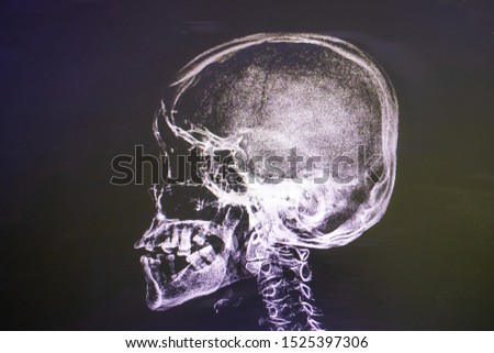 Patient's skull and neck x-ray film