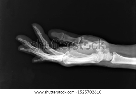 X-Ray Image Of Human Hand. Human Hand X-Ray isolated on black. 