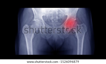 Film X-ray hip radiograph show Left femoral head collapse form Avascular necrosis (AVN) or Osteonecrosis (ON) disease. Right hip show osteoarthritis  joint disorder(OA). Medical technology concept. Royalty-Free Stock Photo #1526096879