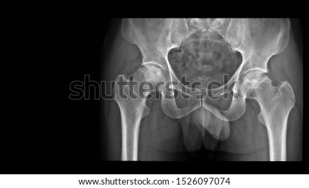Film X ray hip radiograph show bilateral femoral head collapse form bone infarction or avascular necrosis (AVN) or Osteonecrosis (ON) disease arthritis joint. Medical investigation concept. Royalty-Free Stock Photo #1526097074