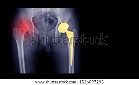 Film X-ray radiograph show Avascular necrosis (AVN) or Osteonecrosis (ON) disease and arthritis joint. Left hip treated by total hip replacement prosthesis (THR) surgery. Right show active disease  Royalty-Free Stock Photo #1526097293