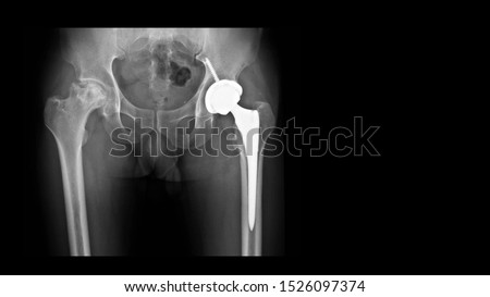 Film X ray radiograph show Avascular necrosis (AVN) or Osteonecrosis (ON) disease and arthritis joint. Left hip treated by total hip replacement prosthesis (THR) surgery. Right show active disease  Royalty-Free Stock Photo #1526097374