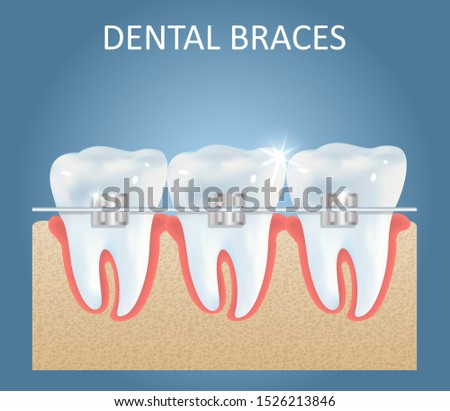Dental braces vector medical education anatomy poster template. Realistic white teeth with brackets. Orthodontics, orthodontic treatment concept.