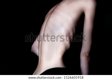 A girl with anorexia turned back, spine and ribs visible. Toned in cold tones for dramatic effect. Royalty-Free Stock Photo #1526605958
