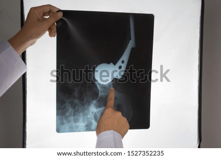 X ray film with doctor's hand to examine. And the doctor's hands are checking the size. Medicine concept