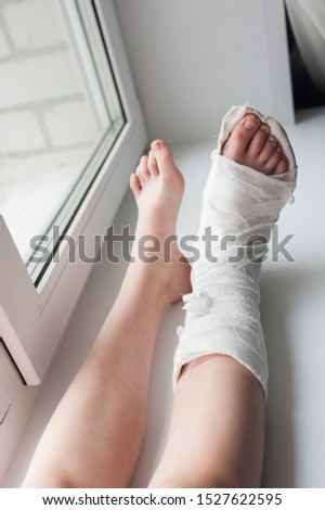 Broken leg in a medical plaster on a windowsill. Human healthcare and medicine concept