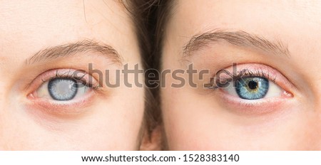 Person with white pupil and healthy eye comparison close up Royalty-Free Stock Photo #1528383140