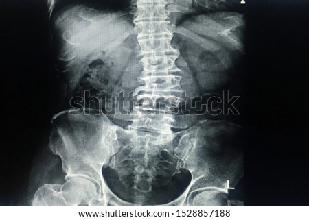 X-ray L-S spine Scoliosis and loss lordosis curve.Narrow L3-4-5 disc space with spur from degenerative change.Normal alignment.No fracture,bony destruction.No opaque calculi.Normal bowel gas pattern. Royalty-Free Stock Photo #1528857188