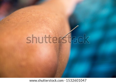 Close up of an acupuncture needle sticking on an unidentified man's elbow. Selective focus. 