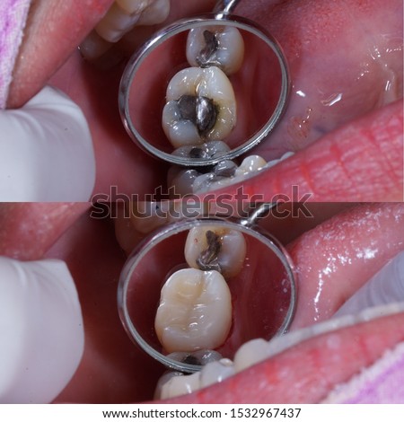 molar tooth show before and after filling Royalty-Free Stock Photo #1532967437