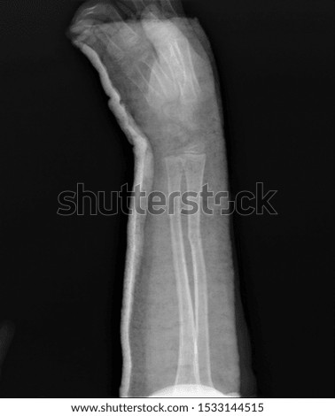 on the x-ray, the fracture of the forearm bones fixed with a plaster spar medicine, diagnostics,traumatology, orthopedics