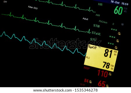 Vital sign monitor screen show patient data.
