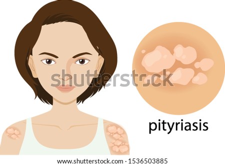 Diagram showing woman with pityriasis illustration