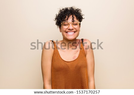 Young african american woman with skin birth mark laughs and closes eyes, feels relaxed and happy. Royalty-Free Stock Photo #1537170257