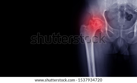 Film X-ray hip radiograph show femoral head collapse form Avascular necrosis (AVN) or Osteonecrosis(ON) disease and progressive arthritis joint. Highlight on painful area. Medical orthropedic concept. Royalty-Free Stock Photo #1537934720