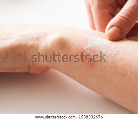 A woman applying scars removal cream to heal the first degree - heat burn wound on her hand. Royalty-Free Stock Photo #1538332676
