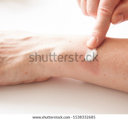 A woman applying scars removal cream to heal the first degree - heat burn wound on her hand. Royalty-Free Stock Photo #1538332685