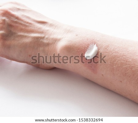 A woman applying scars removal cream to heal the first degree - heat burn wound on her hand. Royalty-Free Stock Photo #1538332694