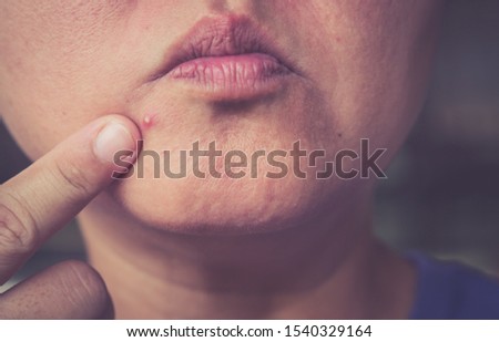 Squeezing the infected pustules acne on the face Royalty-Free Stock Photo #1540329164