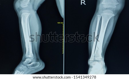 X-ray right leg a boy 3 year old.Showing fracture distal shaft tibia. Royalty-Free Stock Photo #1541349278